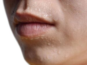 Lip Sweating Treatment in Perth by Perth Sweat Clinic